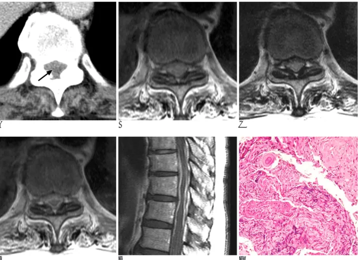 Fig. 1. A 77-year-old man with back pain and paraplegia.