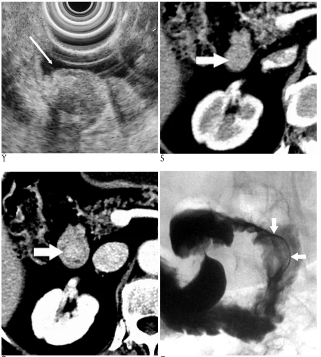 Fig. 1. A. The endoscopic ultrasonogram shows a well-defined mass occupying the mucosal and submucosal layers