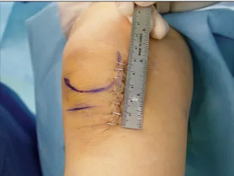 Fig.  1.  The  small  skin  incision  along  the  medial  side  of  the  patella tendon.대상  및  방법    2003년 11월부터 2004년 9월까지 본원 정형외과에서 한 명의 정형외과 의사에 의해 시행된 슬관절 부분치환술의 초기 50예를 대상으로 하였다