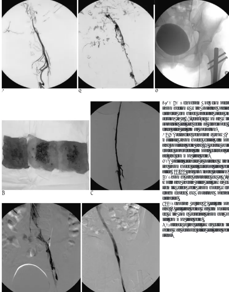 Fig.  2. Venogram of complete thrombectomy with rotating pigtail catheter combined vascular stent  in-sertion in a 38-year-old woman with subacute left leg edema, developed 3 days after left femur operation.