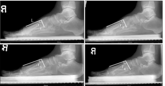 Fig.  1.  The  dorsal  mobility  of  the  first  ray  of  the  foot  was  measured  using  the  modified  Coleman  block  test.
