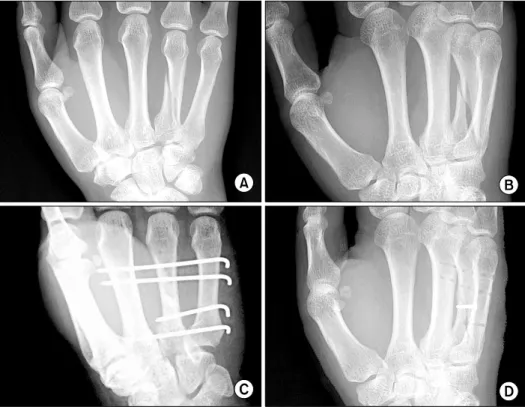 Fig.  1.  Plain  x-rays  of  the  left  hand  (M/45)  show  a  long   obli-que  fracture  of  the  4 th    meta-carpal  fixed  with  a   percuta-neous  mini-screw  and  4   trans-verse K-wires (A, initial AP view;