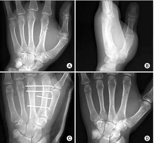 Fig.  2.  Plain  x-rays  of  the  left  hand  (M/32)  show  a  long   obli-que  fracture  of  the  2 nd    meta-carpal  fixed  with   interfragmen-tary  K-wire  and  3  transverse  K-wires  (A,  initial  AP  view;  B,  initial lateral  view; C,  postopera-
