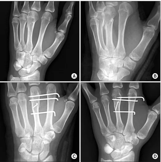 Fig.  3.  Plain  x-rays  of  the  left  hand  (F/30)  show  a  short   obli-que  fracture  of  the  3 rd    meta-carpal  and  a  migrated  K-wire  on  the  follow-up  (A,  initial   obli-que  view;  B,  post-accident  2  weeks  oblique  view;  C,   operati