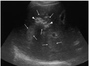 Fig. 1. Sonography shows multiple variable sized hyperechoic masses in both lobes of liver (arrows)