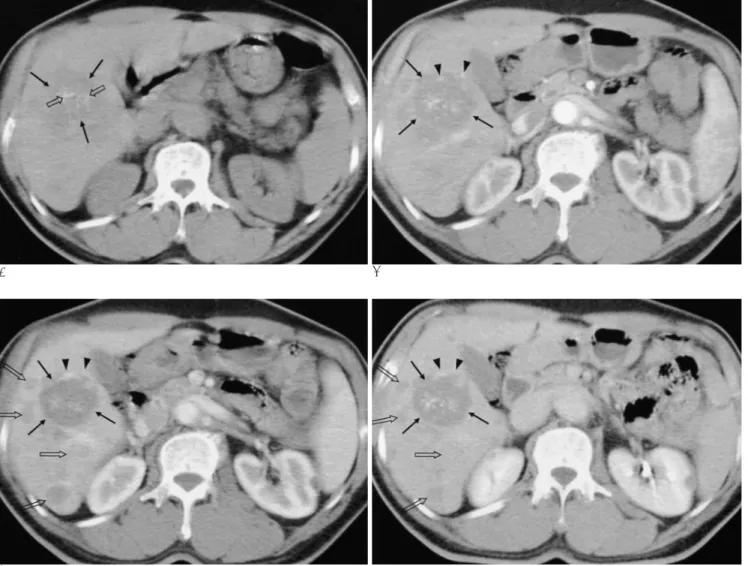 Fig. 2. A. Precontrast CT shows a low attenuated mass (arrows) with multiple spotty calcifications (open arrows) in the right lobe of the liver.