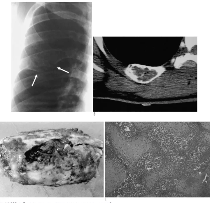 Fig. 1. A 21-year-old man with chondroblastoma of the right sixth rib.