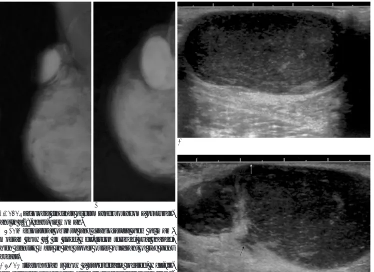 Fig. 1. Radiologic findings of dermatofibrosarcoma protuber- protuber-ans in a 28-years-old woman.