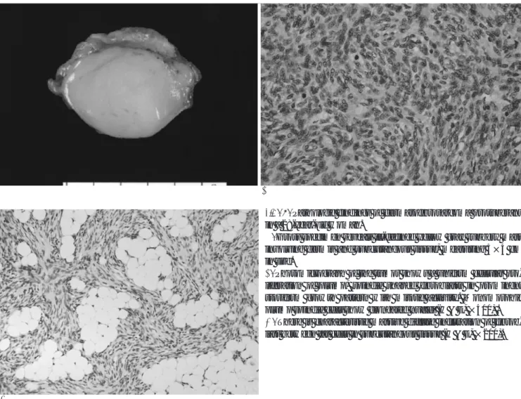 Fig. 2. Pathologic findings of dermatofibrosarcoma protuberans in a 28-year-old woman.