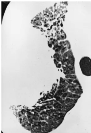 Fig. 3. Large lung cancer is noted in the peripheral portion of the right upper lobe with central bronchial obstruction (not seen here) in a 87-year-old man