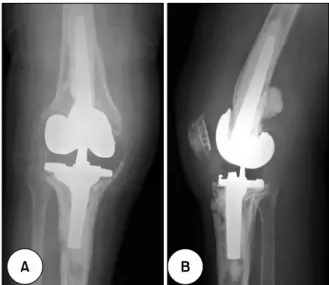 Fig.  1.  Postoperative  (A)  anteroposterior  and  (B)  lateral  radio- radio-graphs  of  a  41months  follow-up  after  revision  arthroplasty  due to  an infection  also show severe osteolytic changes around the implants.