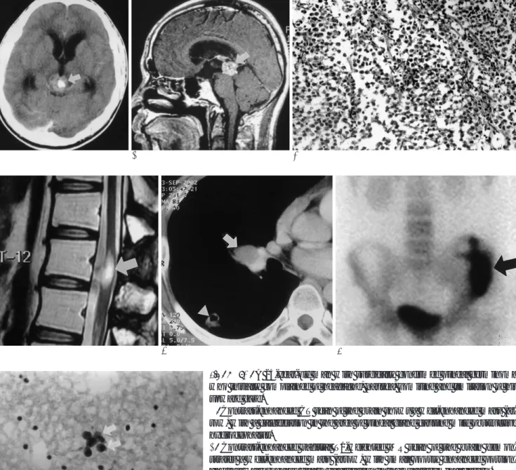 Fig. 1A-C. A 25-year-old man with surgically confirmed pineal germinoma who initially complained of headache, nausea, vomiting and limitation of his upward gaze.