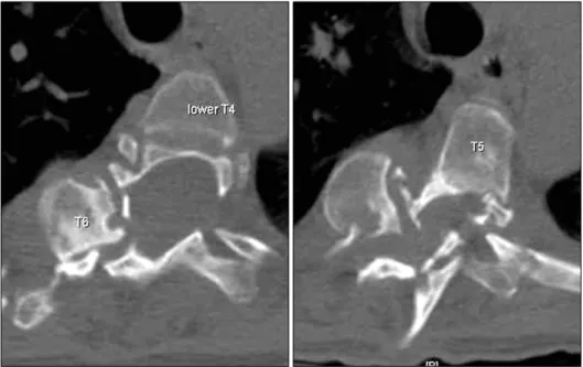 Fig.  3.  Two  consecutive  axial  CT  images  showing  severe   des-truction  and  resorption  of   ver-tebral  pedicles  of  T5  and  7.