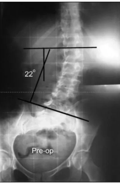 Fig.  2.  The  illustration  of  the  pre-operative  planning  of  the  osteotomy.  The  hatched  marks  define  the  extent  of  the  osteotomy.
