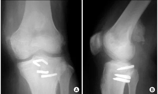 Fig.  1.  The stress  lateral  view of  a  grade  III  posterior  instability.