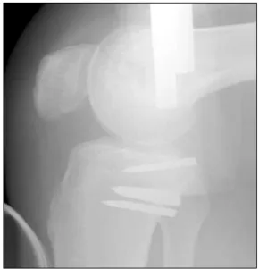 Fig.  3.  The  stress  lateral  view  of  30  months  after  the  excision  operation  showing  no  recurrence  of  heterotopic  ossification  and  good  stability  of  the  PCL.