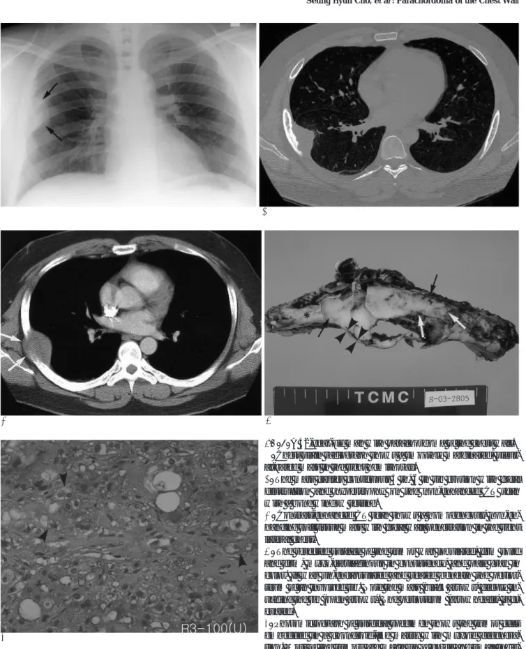Fig. 1. A 32-year-old man with parachordoma of the chest wall.