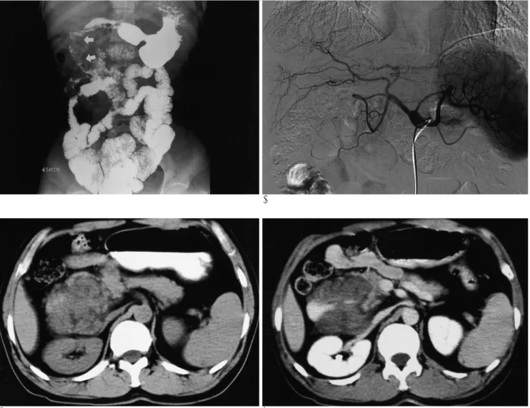 Fig. 1. A. Small bowel follow-through shows widening of the C-loop in 2nd portion of the duodenum (arrows).