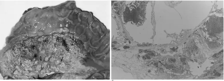 Fig. 2. A. Surgical specimen shows an ill-defined dark red brown colored and semisolid mass with spongy-like consistency in the mesentery and between the duodenum and the pancreas (black arrows), measuring 10×4 cm