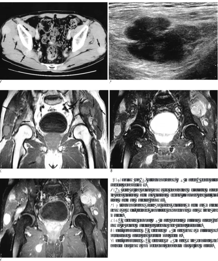 Fig. 2. Follow up CT, ultrasonography, MR images 2 years after radical nephrectomy.