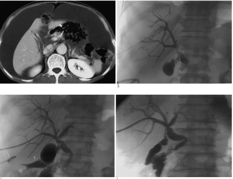 Fig. 1. A 67-year-old man with biliary leak after subtotal gastrectomy.