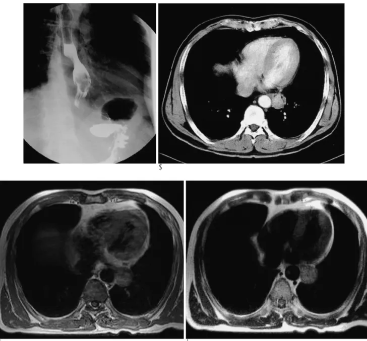 Fig. 1. A 58-year-old man with primary malignant melanocytic melanoma in esophagus.