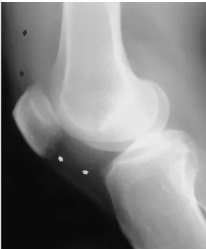 Fig. 1. Lateral radiograph of the knee shows ill-defined soft tis- tis-sue opacity in the infrapatellar area (white arrows) and bulging of the suprapatellar bursa due to joint effusion (black arrows).