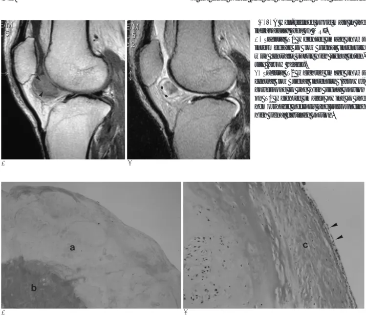 Fig. 2. A well-defined ovoid mass in the infrapatellar area on MRI.