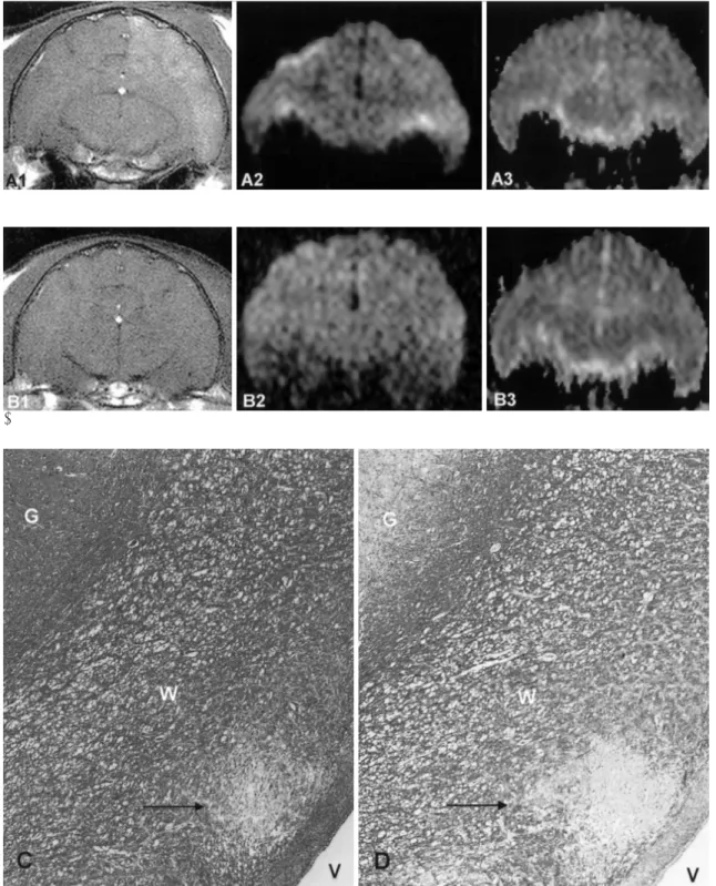 Fig. 1. MR imaging findings of one hour (A) and one day (B) after infusion of linoleic acid emulsion