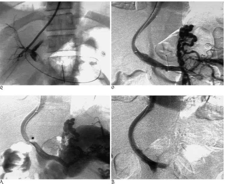 Fig. 3. A 45-year-old man with biliary fistula