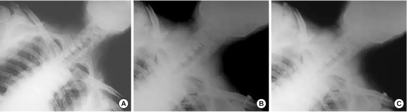 Fig. 1. (A) Thirty eight-year-old man with acromioclavicular dislocation of left shoulder