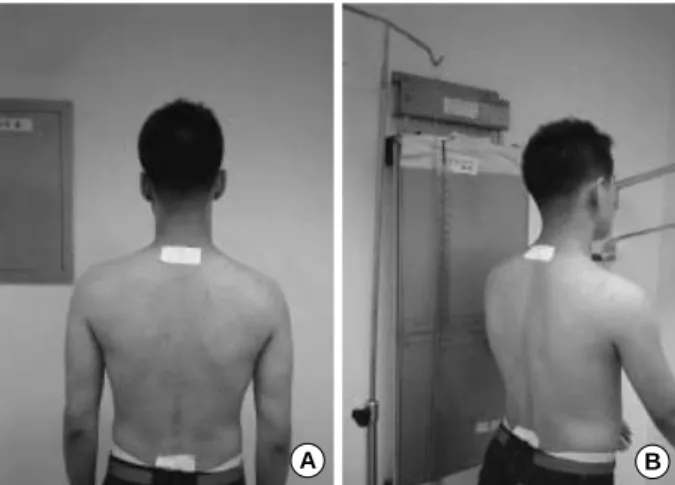 Fig. 1. Subject positioning with surface markers. (A) Before the postural recordings, reflective markers with lead bases for  visual-ization on radiographs were attached to the skin overlying the spinous processes of the C7 and S1 vertebrae