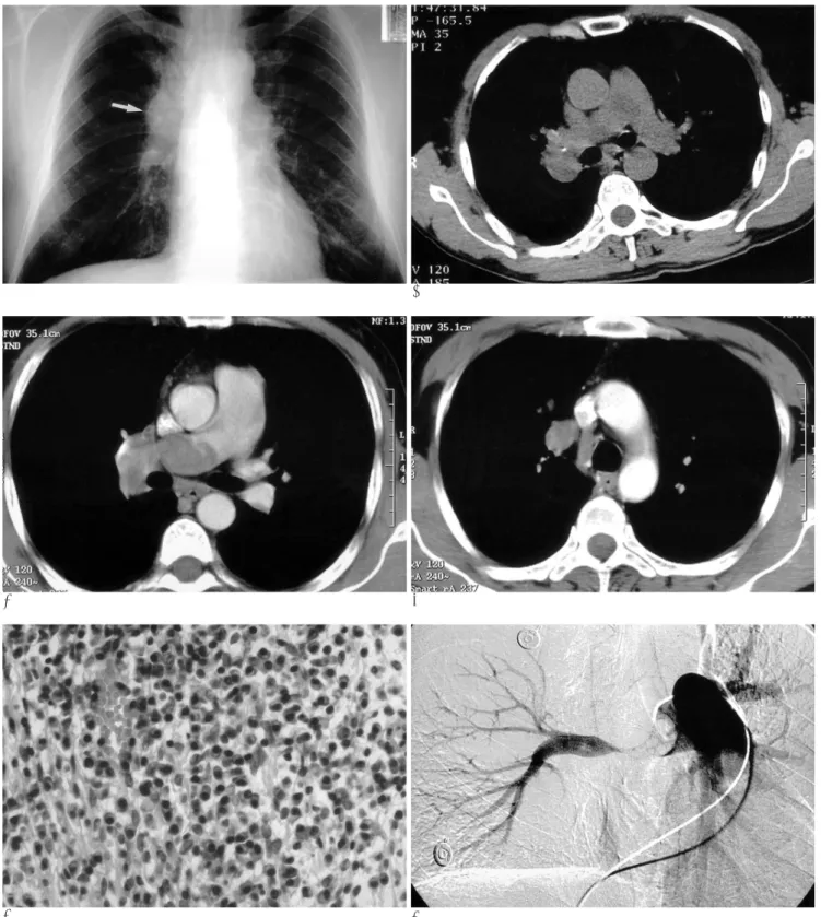 Fig. 1. A 48-year-old man with exertional dyspnea for 1 year.