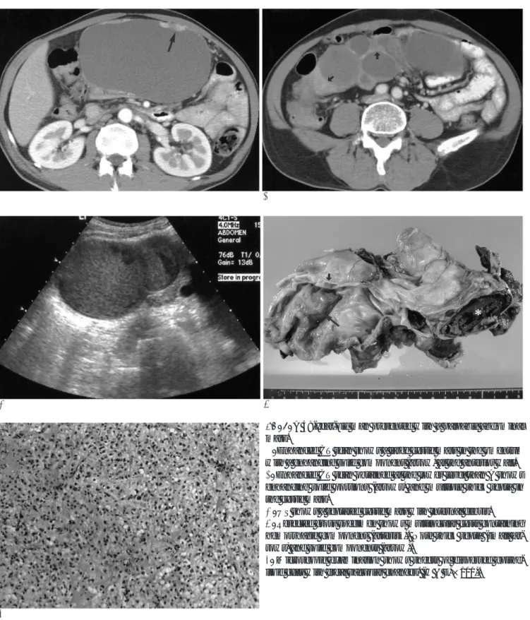 Fig. 1. A 49-year-old man presented with a palpable abdominal mass.