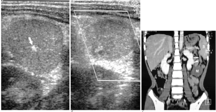 Fig. 1. A 5-year-old boy with infarction in the accessory spleen.
