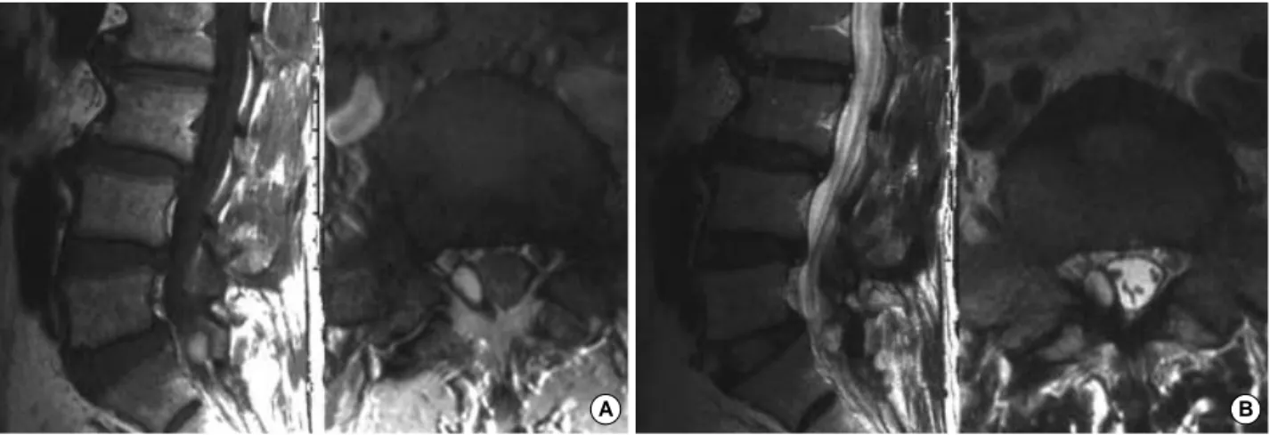 Fig. 2. Follow-up T1 weighted (A) and T2 weighted (B) images at 2 weeks demonstrate an area of increased signal intensity, which suggests a small residual hematoma in the epidural space.