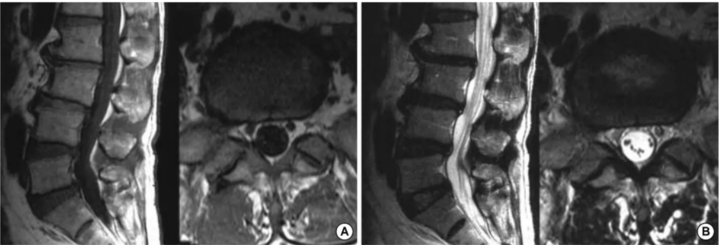 Fig. 3. Follow-up T1 weighted (A) and T2 weighted (B) images at 3 months demonstrate complete resolution of the hematoma and relief of dural compression.
