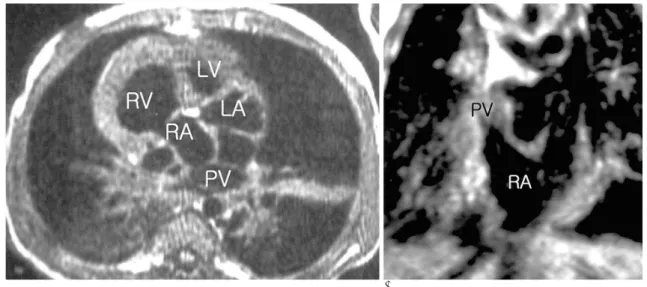 Fig. 2. Total anomalous pulmonary venous return to right atrium and double-outlet right ventricle with ventricular septal defect.