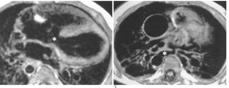 Fig. 7. Pulmonary atresia with VSD. 