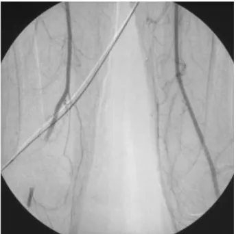 Fig. 3. Doppler finding shows an image of pulsating posterior tibi- tibi-al artery on the foot at postoperative two weeks.