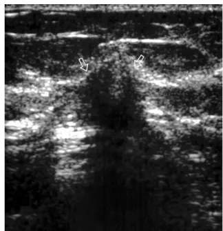 Fig.  2.  Ultrasonogram of the left breast revealing a 1.5 cm sized, ill-defined, and irregular hypoechoic lesion with  posteri-or shadowing (arrows) in the 10 o’ clock position in the left breast, 3 cm away from the nipple.
