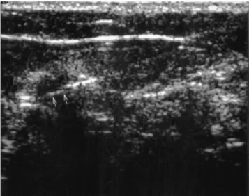 Fig. 3. Ultrasonogram confirming that the needle (arrows) tra- tra-versed the mass. 
