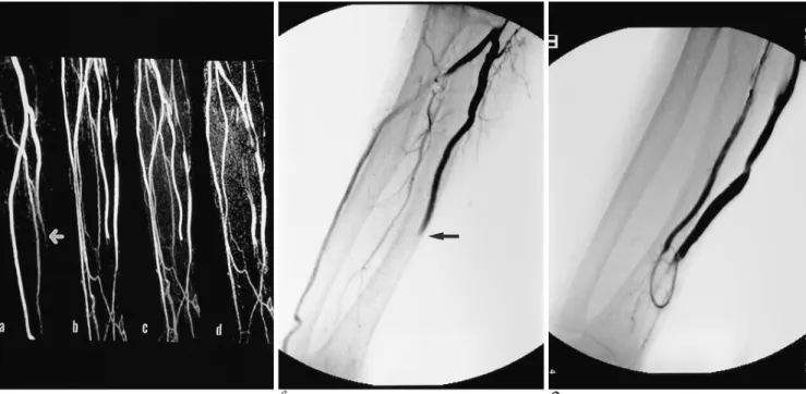 Fig. 2. MIPs of a four phase CE-MRA (13 second intervals) and the DSA of a U-loop PTFE graft AVF obtained from the left arm of a 75-year-old male patient.