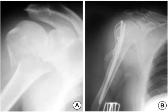 Fig. 2. (A) Eighty one years old woman with a surgical neck frac- frac-ture of the proximal humerus