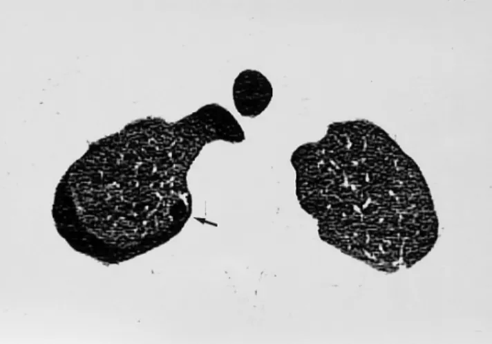 Fig. 1. A 23-year-old man with spontaneous pneumothorax.