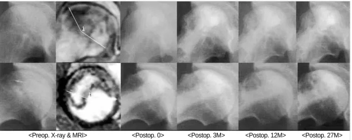 Fig. 3. 32-year-old female patient. Preoperative X-ray and MRI showing Ficat stage 2-a and INE B