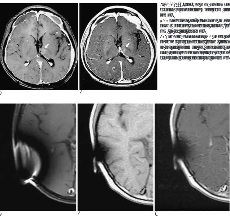 Fig.  4. A 13-year-boy who underwent excision of suprasellar mixed germ cell tumor.