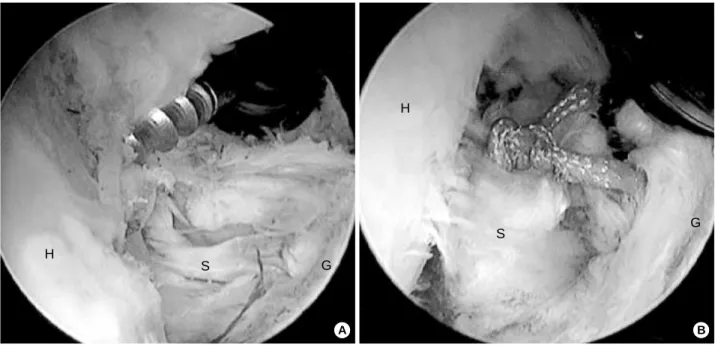 Fig. 3. (A) Arthroscopic view of a partial thickness tear of the subscapularis tendon was seen from the posterior portal