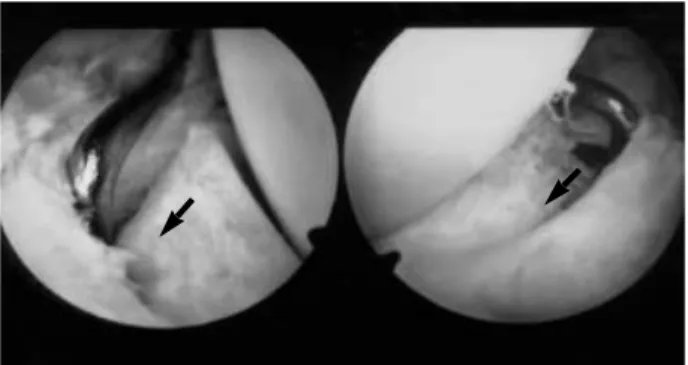 Fig. 3. Two different cases of tear sutured with absorbable suture material seen from posteromedial portals.