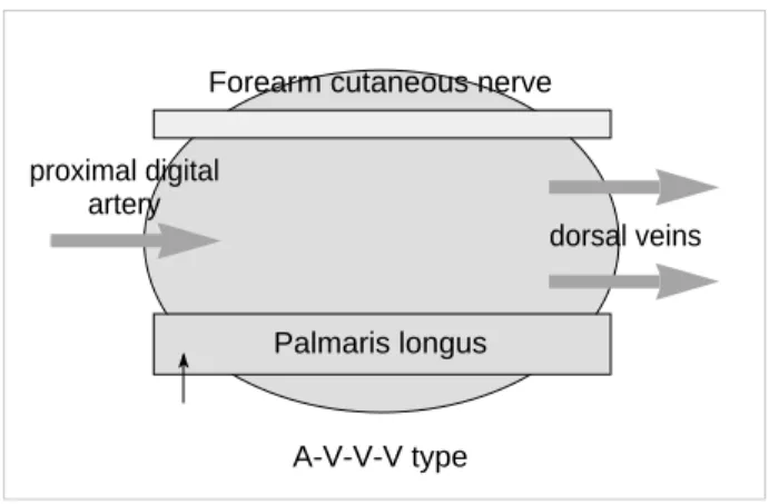 Fig. 1. Schematic diagram of the tendocutaneous arterialized venous flap.